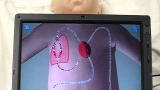 Mixed simulation of a neonate METI BabySIM with Hypoplastic Left Heart Syndrome Patent Pending [upl. by Terencio]