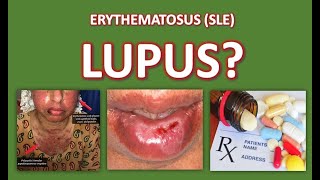 What is Lupus [upl. by Carmelle]