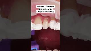 Composite Bonding Smile Makeover dentalrestoration teethwhitening dentalmakeover [upl. by Yereffej]