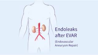 Endoleaks after Endovascular Repair of Thoracic Aortic Aneurysms EVAR [upl. by Nnylatsirk]