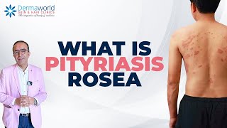 Skin Rash Pityriasis Rosea Hai  Symptoms Aur Treatment Explained  dermaworldskinclinics [upl. by Keifer]