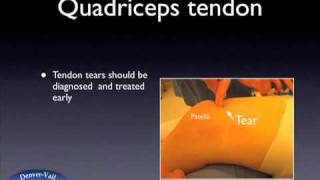 Quadriceps Tendon Tear [upl. by Eelhsa]