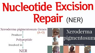 DNA Repair mechanism  Nucleotide Excision Repair II Xeroderma pigmentosum cause and features [upl. by Eitsirc]