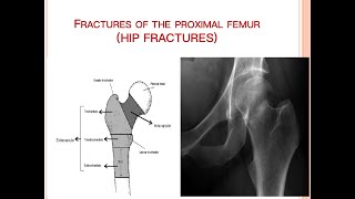 Fracture of Proximal Femur [upl. by Rey977]