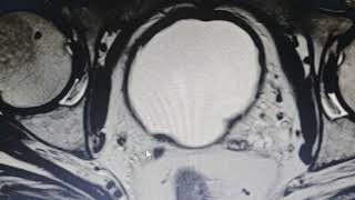 Rare unilateral agenesis of a seminal vesicle  MRI findings [upl. by Ahsap652]