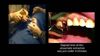 Physics Forceps Atraumatic Tooth Extraction Technique  Dr Carl Misch [upl. by Keli877]