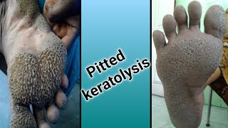 Pitted Keratolysis [upl. by Hayton]