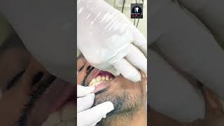 save tooth🙏replaced missing teeth 🙏health tipdr Alka khade [upl. by Yorled]