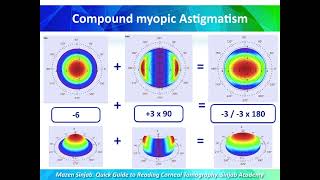 A Quick Guide to Reading Corneal Tomography Part 3 [upl. by Bilbe728]