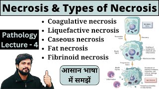 Necrosis and Types of Necrosis in Hindi Pathology Lecture Notes Bsc Nursing GNM MLT Pharmacy [upl. by Ahsinroc]