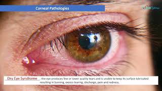 Optician Training Corneal Pathologies Ocular Anatomy Lecture 22 [upl. by Gerhard445]