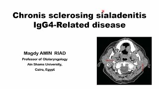 Chronic Sclerosing Sialadenitis IgG4 Related disease [upl. by Suirad794]