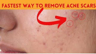 Experts Agree This is the FASTEST Way to Remove Acne Scars [upl. by Galan313]