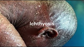 What is Ichthyosis  Ichthyosis Treatment in Homeopathy [upl. by Camden]