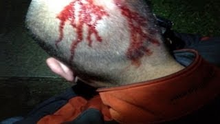 Zimmerman Injuries Seen in Exclusive Photo Pictures from Night of Trayvon Martins Death [upl. by Neras]