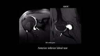 MRI shoulder labrum pathology [upl. by Siwel]