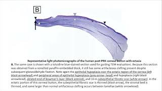 Corneal Ectasia Basics – A Deep Dive [upl. by Lamrouex]