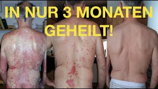 Schuppenflechte  in 3 Monaten geheilt ohne Kortison [upl. by O'Neill540]