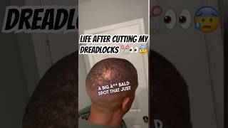 From Dreadlocks to Bald Spots My Journey and Shocking Results hairloss alopeciajourney [upl. by Alithea]