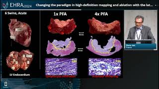 EHRA Congress 2024 Highdefinition mapping and ablation [upl. by Dnarud]