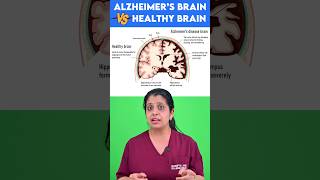 Alzheimers brain vs Healthy brain🧠 [upl. by Netloc]