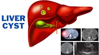 Liver cyst  What do you need to know about liver cysts  247nht [upl. by Hanshaw315]