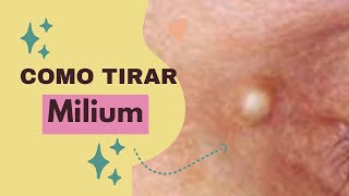 Como tirar milium durante a Limpeza de Pele  Você sabe o que é milium estetica milium [upl. by Marih]