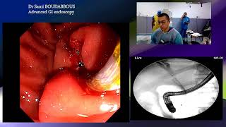 ERCP with SEMS [upl. by Weinert]