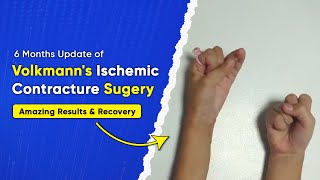 Volkmanns Contracture Surgery Update A Childs Incredible Healing Process Over 6 Months  Part 2 [upl. by Arraeit]