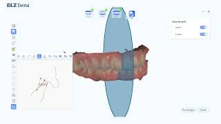 Intraoral Scanner Measurement Tool Using Guides [upl. by Millham]