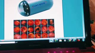 capsule endoscopy gastric analysis التنظير بالكبسولهتحليل حمض المعده [upl. by Bax]