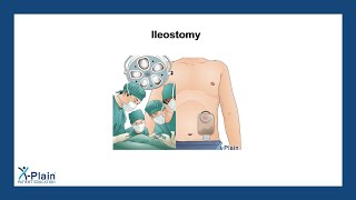 Ileostomy [upl. by Amuh550]