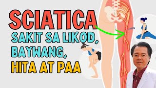 Sciatica Sakit sa Likod Baywang Hita at Paa  By Doc Willie Ong at Doc Liza Ong [upl. by Pammy322]