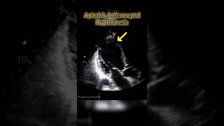 Apical and Anteroseptal Hypokinesia on Echocardiography heartphysiology anatomy heart [upl. by Akemor]