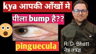 Pinguecula couses and Treatment pinguecula kya होता है और इसका ईलाज़ पीला bump [upl. by Refinnaj200]