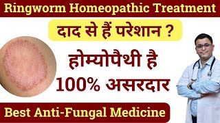 Ringworm homeopathic medicine Ringworm treatment at home Best Homeopathic medicine for Ringworm [upl. by Chaiken]