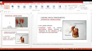 Periapical Granuloma [upl. by Noevad785]
