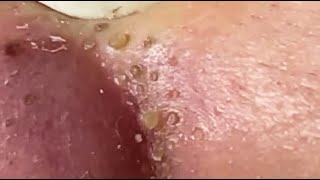 TOP OF BLACKHEADS REMOVAL FROM THE NOSE 😨 relaxing blackheads [upl. by Ahsimit]