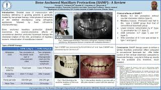 Bone anchored maxillary Protraction BAMP  A review  Dr Raman Dhungel [upl. by Ardath199]