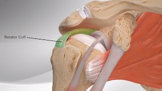 Superior Capsular Reconstruction [upl. by Aidroc819]