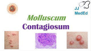 Molluscum Contagiosum “Papules with Belly Buttons” Risk factors Symptoms Diagnosis Treatment [upl. by Elo523]