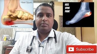 HEEL PAINCALCANEAL SPUR TREATMENTएड़ी के दर्द का इलाज [upl. by Aliek]