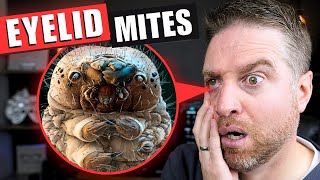 How to Get Rid Of Eyelid Mites That Cause Demodex Blepharitis [upl. by Awahsoj458]