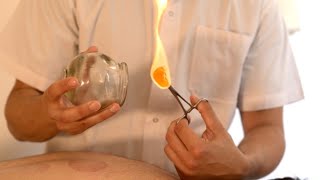 How To Do Fire Cupping [upl. by Hesler204]