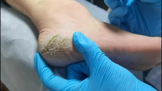 Pedicure  Wow Look at cracked heels Dead skin removal and Cracked heels treatment [upl. by Nwahsram]