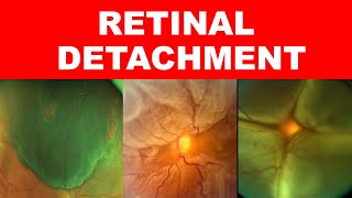 Retinal Detachment Types Risk Factors Pathophysiology Symptoms and Signs [upl. by Neeka499]