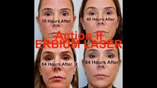 Action II Erbium Laser Resurfacing  Stepbystep procedure start to finish with Dr Weiner [upl. by Filemon]