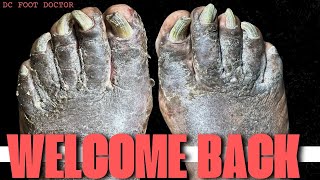 Welcome Back  Fungal Toenails and Severe Fungal Dermatitis [upl. by Etnovad]