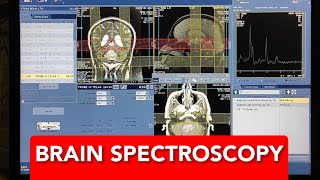 Brain Spectroscopy protocol positioning and planning on GE 15 Tesla  Live Demo [upl. by Tedd]