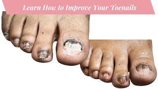 How to Nail Fungus Toenail Recovery 3rd Visit [upl. by Carling]